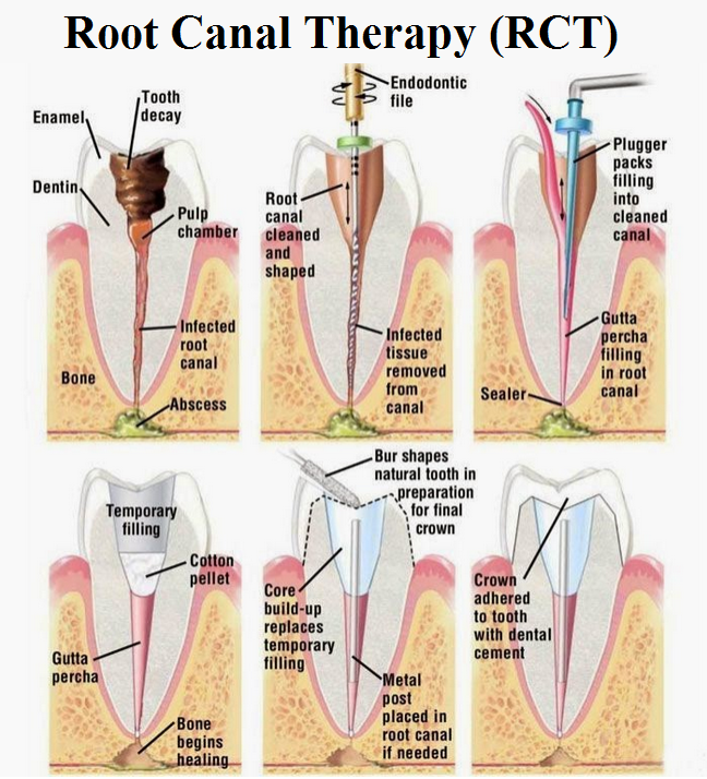 How Does Root Canal Treatment Keep Your Natural Tooth Safe And Functioning