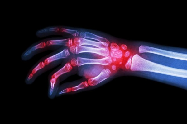 Rheumatoid Arthritis Week - What We Learned